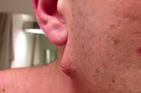 What does ingrown hair bumps look like. This Guy Has The Most Insane Ingrown Hair You Ve Ever Seen