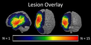 Increased Recruitment Of Domain General Neural Networks In Language Processing Following Intensive Language Action Therapy Fmri Evidence From People With Chron Aphasia Therapy Assessment Intense