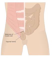 Check spelling or type a new query. Ce Este Si De Ce Apare Hernia Inghinala Cauze Simptome Metode De Tratament Si Prevenire