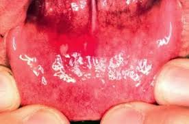 Image result for Hand foot and mouth disease HFMD roof of mouth