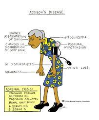 All For Nursing Ms Addison S Disease Vs Cushing S Disease Nursing Care Plan Nursing Care Fundamentals Of Nursing