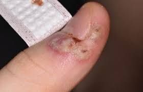 Image result for syphilis ulcer