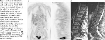 In a study published by brihaye and colleagues, 1,477 cases of spinal metastases were reviewed and found that 16.5% arose from primary tumors in the breast, 15.6%. A 50 Year Old Female With Breast Cancer Presenting With Back Pain A 18 Download Scientific Diagram