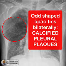 Almost always involve parietal … The Xray Doctor Answer Calcified Pleural Plaques Very Likely Secondary To Previous Exposure To Asbestos The Spectrum Of Asbestos Related Benign Pleural Disease Includes Pleural Effusions And Pleural
