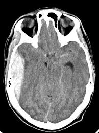 Medical definition of middle meningeal artery. Epidural Hematoma Due To Middle Meningeal Artery Injury Radiology Case Radiopaedia Org