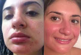 Pin On Raw Foodist Before And After