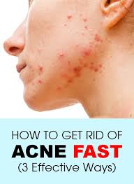 How To Get Rid Of Acne Fast 3 Effective Ways How To Get Rid Of Acne Natural Acne Treatment Acne Cure