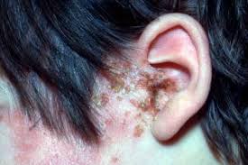 Image result for shingles in children