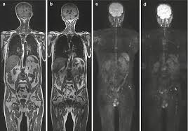 Spitfire volume 3 (the beast within) (hosted by ras kass). Approaches For Assessment Of Response Of Bone Metastases To Therapies Springerlink