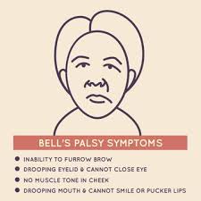 Or it might be a reaction that occurs after a viral infection. Simran S Apurva Asrani Has Bell S Palsy Causes Symptoms Cure Of The Painful Condition Health Hindustan Times
