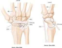 Image result for Scapholunate Dislocation
