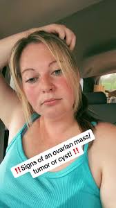 Sign Ng Ovarian Cyst