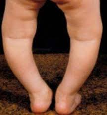 Image result for Rickets