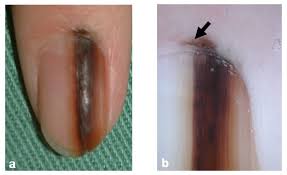 Image result for Acral lentiginous melanoma nail