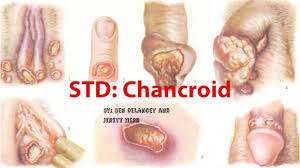 Image result for chancroid