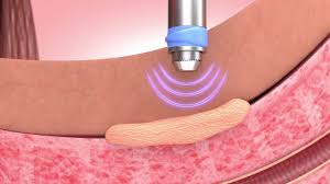This scar tissue can often make it difficult or impossible to have a normal erection. Peyronie S Disease Treatment Animation Youtube