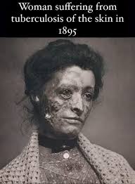 Historical Effects of Syphilis and its Treatment