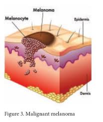 Keep in mind that … Management And Treatment Of Skin Cancer In Older Patients