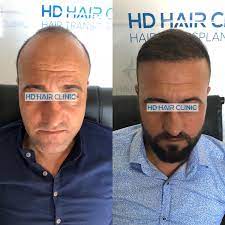 6 Ay Sonra Ki Degisim 5000 Greft Sac Ekimi Ve Profesyonel Ekip Ile Emin Ellerdesiniz Bizi Tercih Eden Ha Hair Clinic Mens Sunglasses Mirrored Sunglasses Men