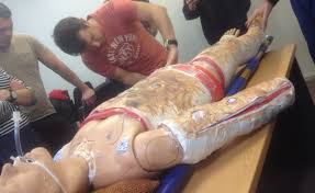 A thick, coagulated crust, slough which develops following a burn injury or chemical or physical cauterization of skin.• in full thickness circumferential burns, coagulated collagen acts as a tourniquet in leading to vascular compromise of the affected body parts.• Build Your Own Escharotomy Man Greater Sydney Area Hems