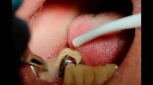 Never pull an abscess tooth, it will drain pus in your mouth leading to more oral problems. Explosive Drainage Of Pus From A Dental Abscess Youtube