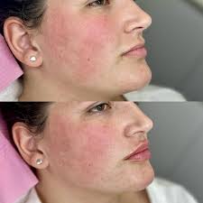 We loved how these lips turned out 😍😍😍 Want to start your lip filler  journey? Contact us via WhatsApp to book your appointments. +27 (082) 385  3320 **patient approved media release**