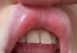 Ursachen der schwellung der oberlippe nach innen. Lippe Geschwollen Gesundheit Herpes Zahnschmuck