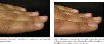 Image result for Koilonychia feet