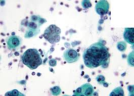 The most useful cytological features of malignant mesothelioma include the . Cytology Mulberries Mesothelioma In Pleural Effusion With A Rather Unusual Multinucleated Appearance Https T Co Gw562rv0z3 Facebook