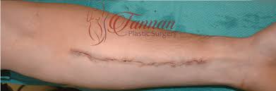 The resultant wound is usually then put back together with stitches (sutures). Tattoo Removal Tannan Plastic Surgery Raleigh Chapel Hill Durham Nc
