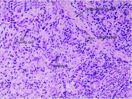 Idiopathic Orbital Inflammatory Syndrome Clinical Features And Treatment Outcomes Abstract Europe Pmc