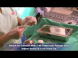 Copperman suggests that before you start the process you have a session. Procedure Of Intrauterine Insemination Sciivf