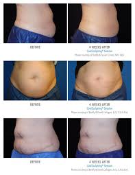 Coolsculpting Before After Photos Cool Sculpting Coolsculpting Before And After Before After Photo