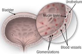 Finding blood in the urine should be enough to get your attention. Interstitial Cystitis Harvard Health