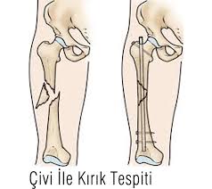 Femur Uyluk Kemigi Saft Kiriklari Prof Dr Levent Altinel Antalya Ortopedi Doktoru Meniskus On Capraz Bag Diz Protezi Kalca Protezi Ortopedi Ve Travmatoloji Ortopedi Uzmani Ortopedi Cerrahisi Kireclenme Omuz Artoskopisi