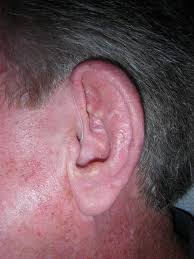 Some types of skin cancer are more dangerous than others, but if you have a spot. Before And After Mohs Surgery Reconstructive Plastic Surgery Squamous Cell Carcinoma Skin Flaps Photos