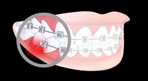 Auch wenn ihr kind den fremdkörper im mund als einen makel empfindet, sind unsichtbare zahnregulierungen eine alternative. Zahnspangen Kfo Roloff