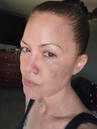 ISO Dermatologist Since Dr. Andreozzi retired, I've had my family doctor do  my scans. However, i need to have a questionable mole removed from my face  and I am very weary. I've