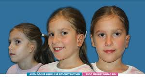 A well-made new ear is indistinguishable from a normal ear. We make  “bespoke” new ears with each patient's own tissues. Look at this 8-year-old  charismatic young man who was born with unilateral