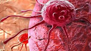 The ways of human papiloma viral infection (пви) distribution were considered, as well as etiology and epidemiology of the diseases associated with human papilloma virus, risk factors and approaches to пви therapy in women. Waspada Kanker Serviks Stadium Awal Tidak Ada Gejala Apapun Tapi Tribun Jabar