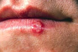 After diligently analyzing the pictures let me reassure you first that overall there is no appearance or resemblance to any sexually transmitted infection in your case including hsv. Herpes Pictures Symptoms Of Herpes Simplex Live Science