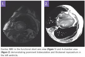 Image result for Left Ventricular Noncompaction