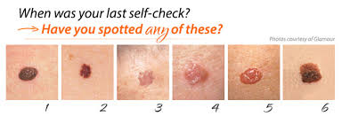 Early signs can include a sore or lump that does not heal on the lips or in the mouth. Melanoma What Does Skin Cancer Look Like Kimaja Farwani