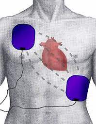 (medicine) an electronic device used internally or externally that delivers a controlled electric shock to a patient to correct ventricular fibrillation. Defibrillators Meaning In Tamil