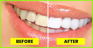 15 simple ways to get white teeth overnight