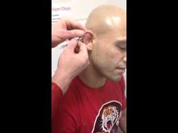 Ufc fighters have weird looking ears to due the trauma the ears receive during grappling training, such … but perhaps you've also wondered, what type of martial arts are they using? Proper Treatment For Cauliflower Ear Wrestling Jiu Jitsu Mma Youtube