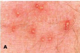 Most mites do not bite humans, but they may bite if they remain on a person's skin. Pyemotes Herfsi Wikiwand