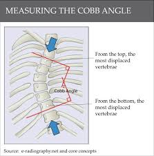 Understanding Cobb Angles And What It Means For Scoliosis