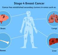 Where Breast Cancer Spreads: Common Sites of Metastasis