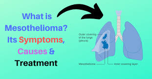 Consult a doctor for medical advice. What Is Mesothelioma Its Symptoms Causes Treatment Realinfo